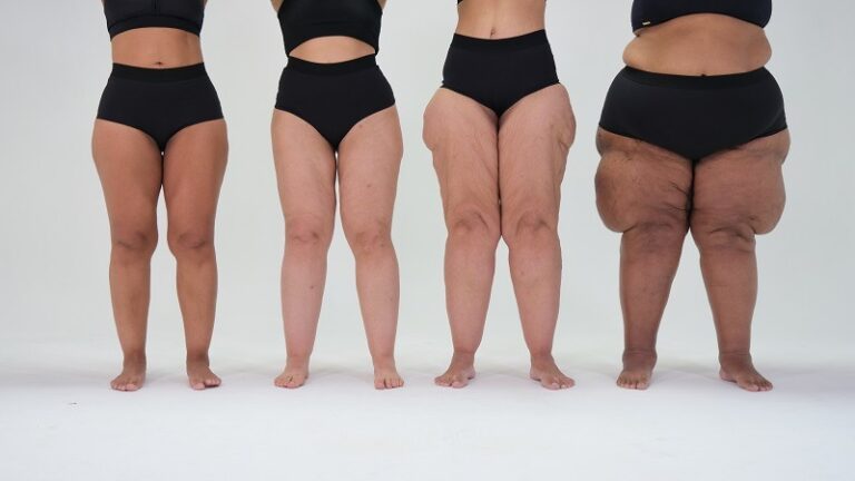 04124257 lipedema g4x2Uu
